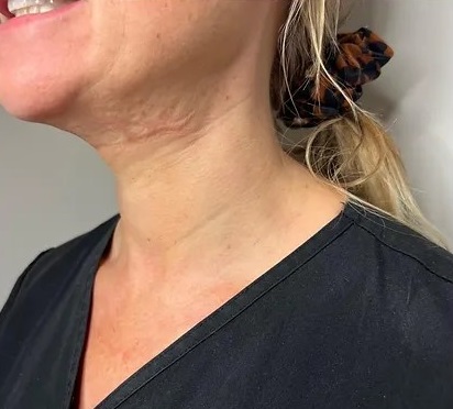 Discover the Secret of Youthful Beauty with Nefertiti Lift Injection&nbsp;Points