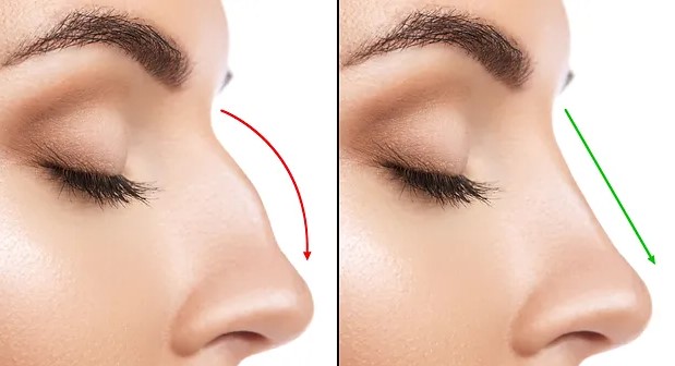 Nose Dermal Filler